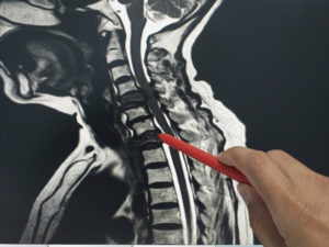 Got Lumbar Spinal Stenosis? Stop Doing These 4 Things NOW - PMIR