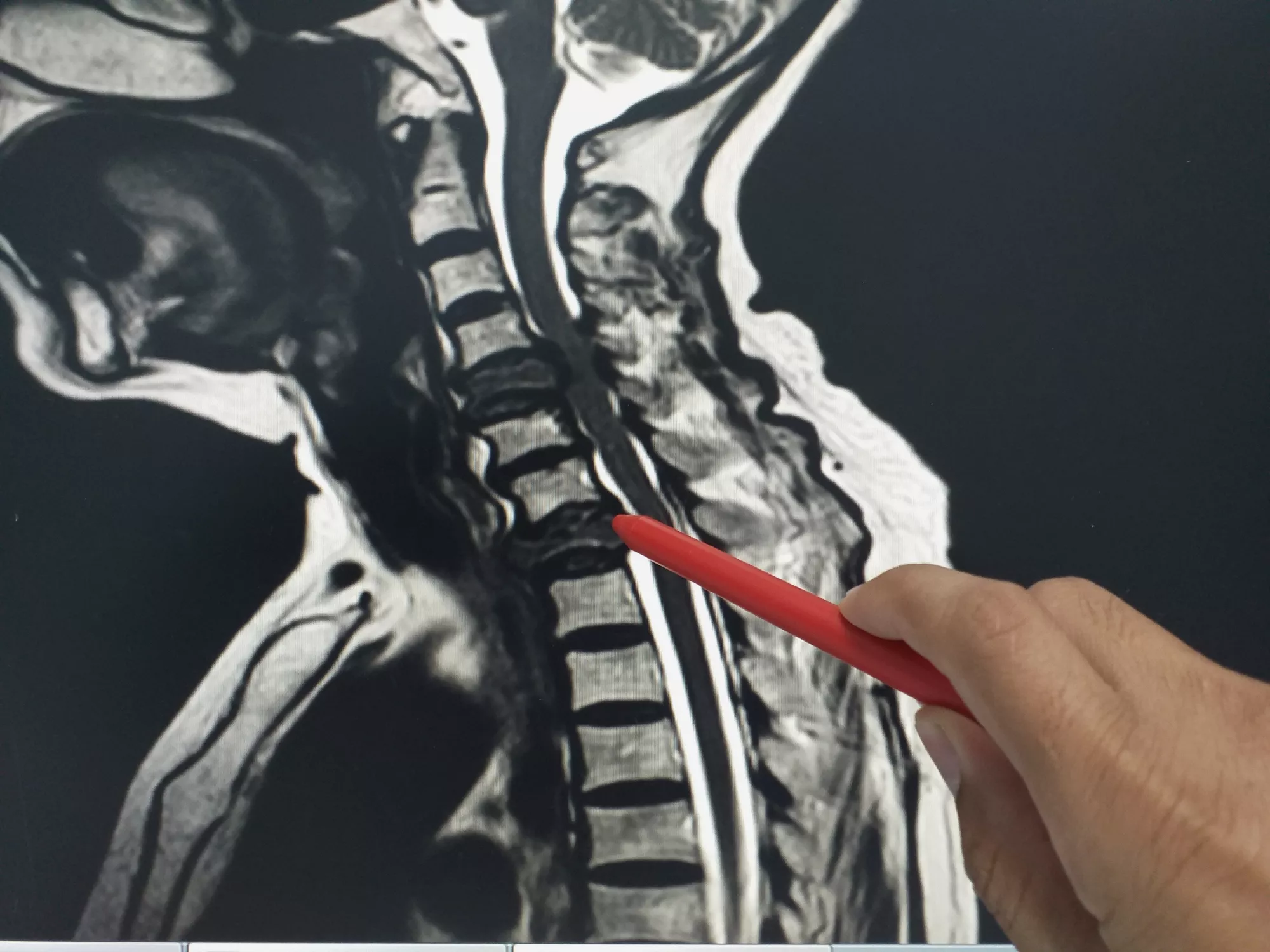 Got Lumbar Spinal Stenosis? Stop Doing These 4 Things NOW - PMIR