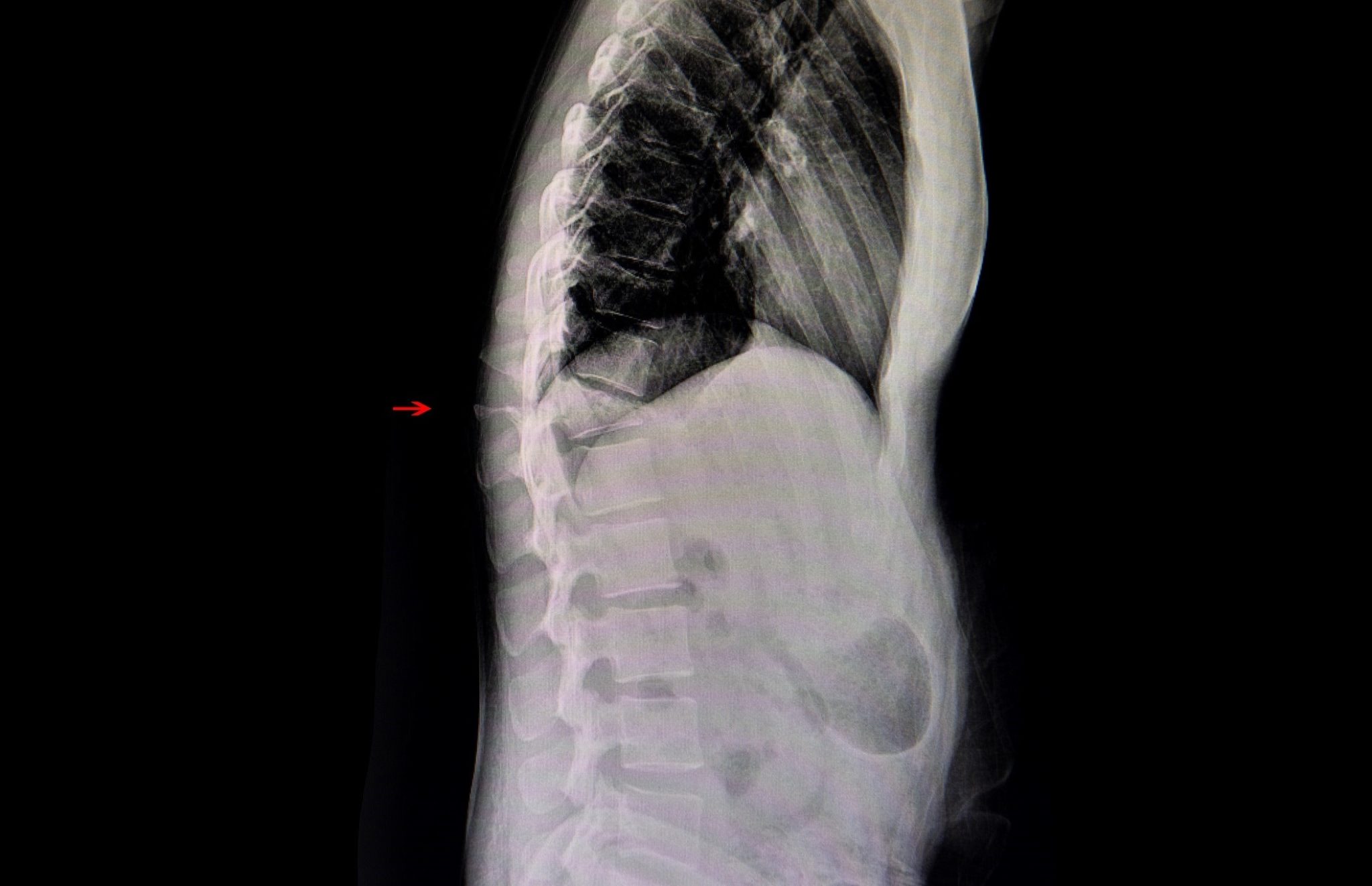 What to Know About Compression Fractures PMIR Medical Center