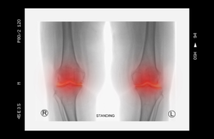 Acute vs Chronic Pain: Differences and Causes - PMIR Medical Center