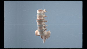 Lumbar Herniated Disc + Pain Relief Tips - PMIR Medical Center