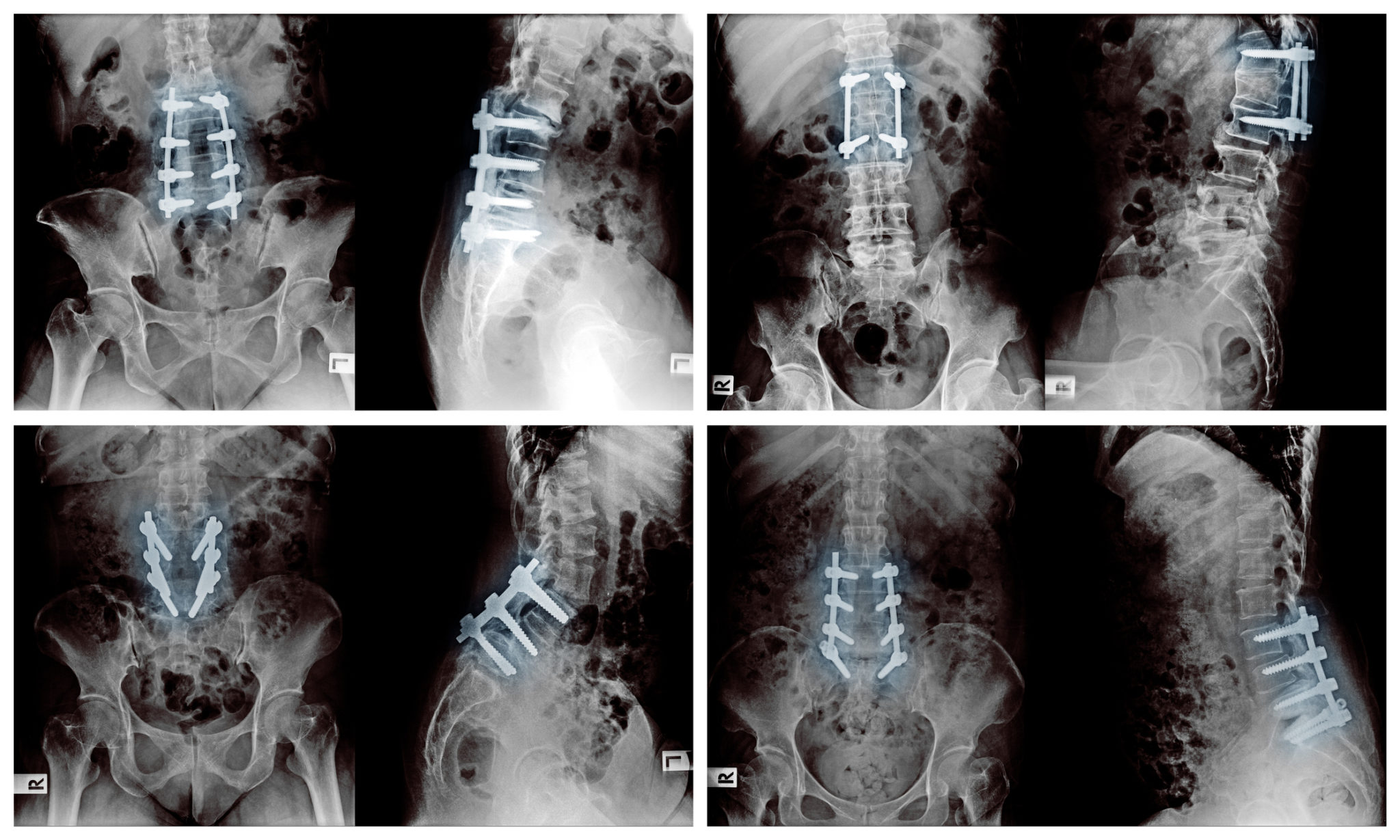 What Are Herniated Discs? PMIR Medical Center
