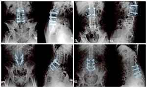 What Are Herniated Discs? - PMIR Medical Center