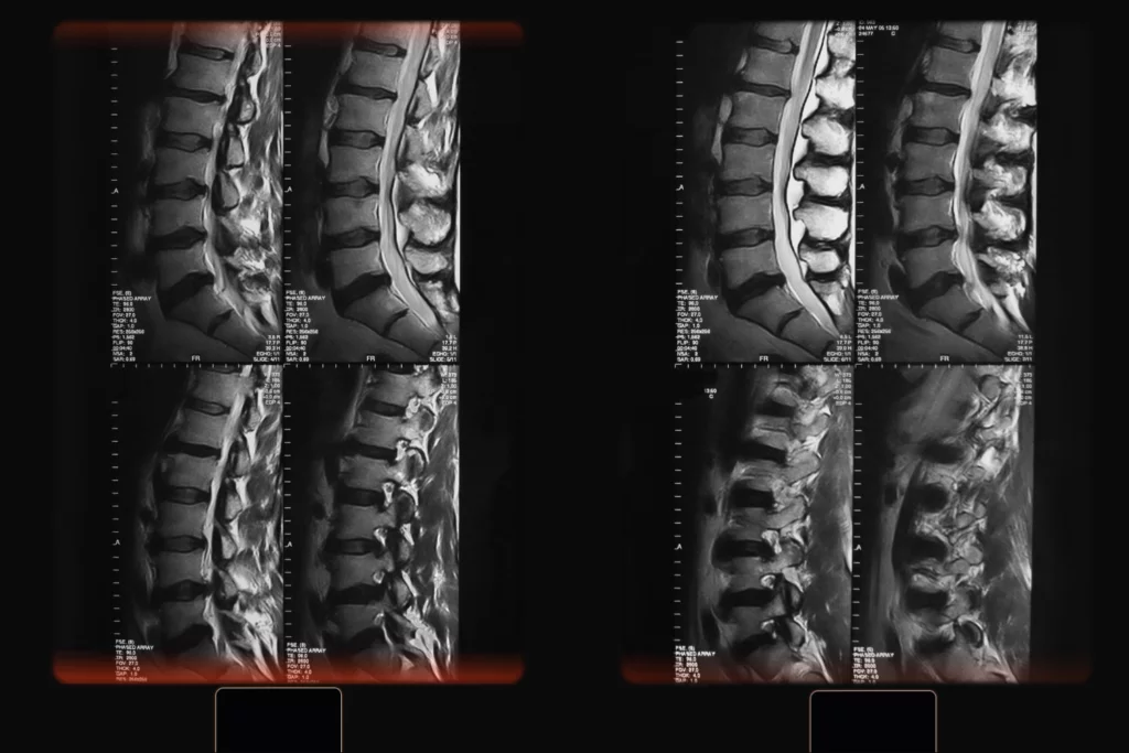 Spinal Arthritis: Symptoms, Diagnosis & Treatments - PMIR Medical Center