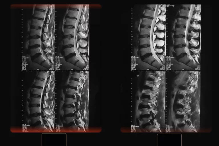 Spinal Arthritis Symptoms, Diagnosis & Treatments PMIR Medical Center