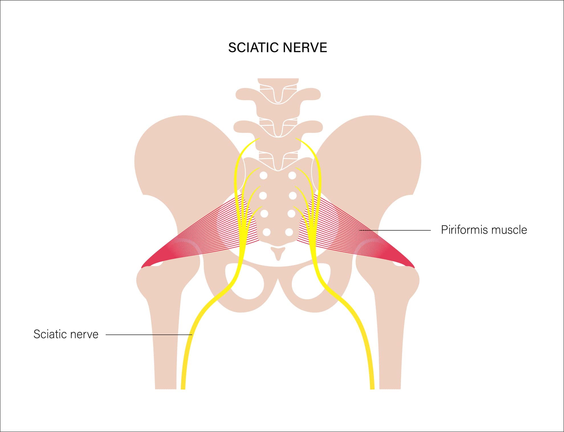 What is the end and long-lasting relief of piriformis syndrome