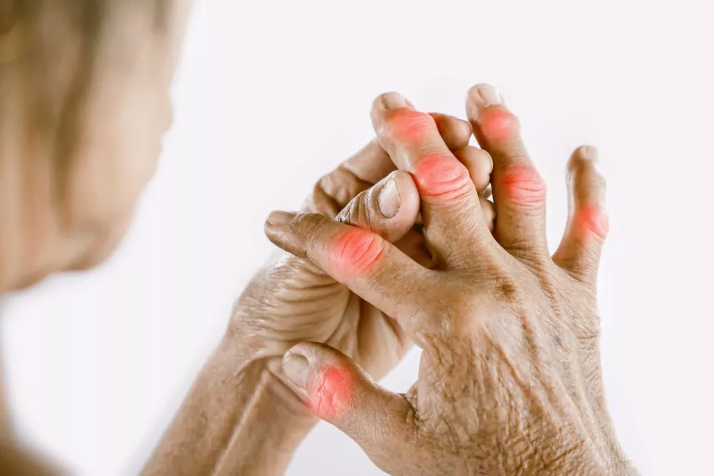 Arthritis Relief: Getting to the Root of Your Pain - PMIR