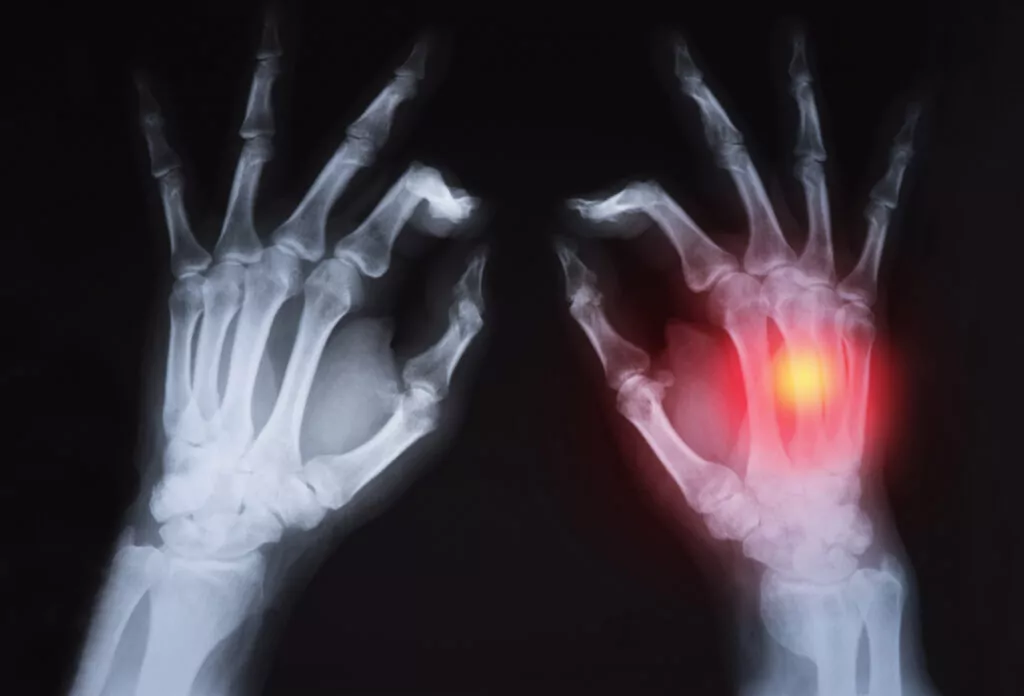 Key Differences Between Osteoarthritis vs Rheumatoid Arthritis - PMIR