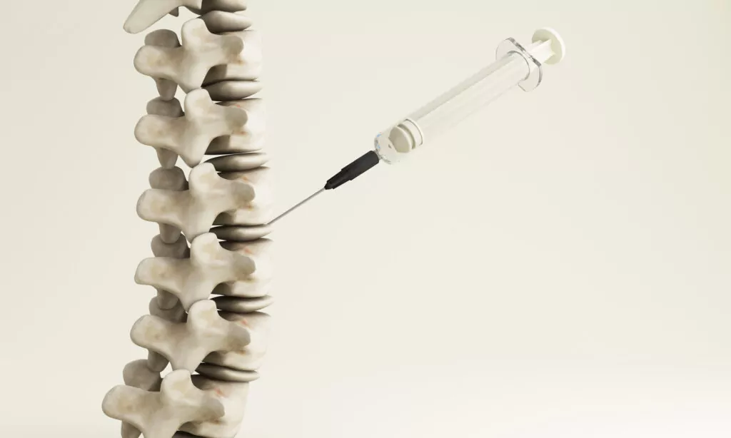 What to Do When Epidural Injections Don’t Work PMIR