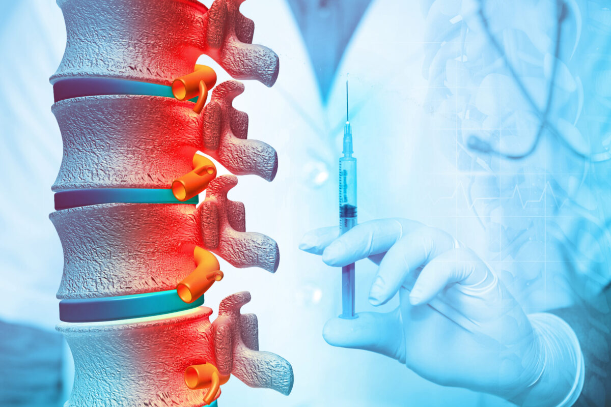 How Often Can You Have Epidural Steroid Injections? - PMIR